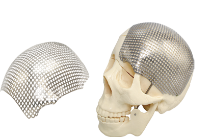 Great News! Chunli Medical’s Titanium Mesh Plate System Has Obtained Marketing Authorization and Launched onto the Market!