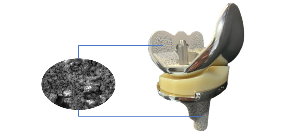 The Future Is Here | Clover Biotype Total Knee System Empowers Joint Regeneration Through Technological Innovation!